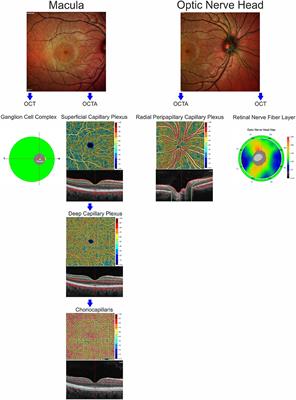 Peripapillary Vessel Density as Early Biomarker in Multiple Sclerosis